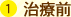 1.治療前