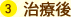3.治療後