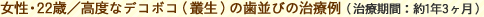 1.女性・22歳／高度なデコボコ（叢生）の歯並びの治療例（治療期間：約1年3ヶ月）