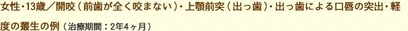2.女性・13歳／開咬（前歯が全く咬まない）・上顎前突（出っ歯）・出っ歯による口唇の突出・軽度の叢生の例（治療期間：2年4ヶ月）