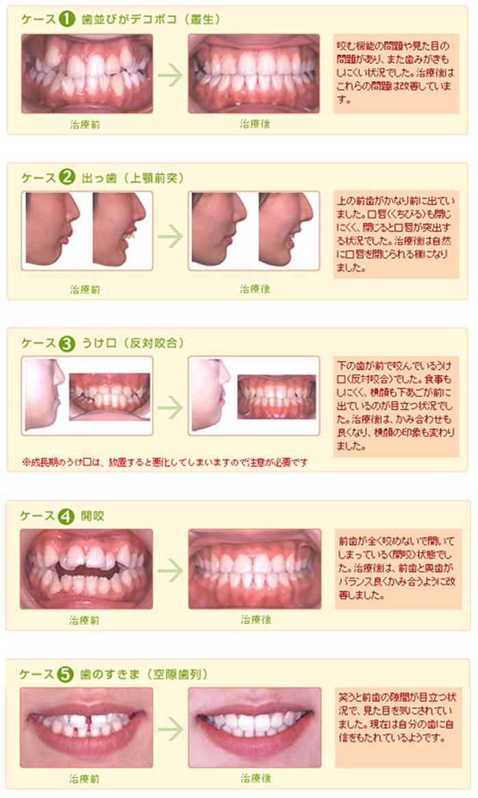 歯並び 悪い